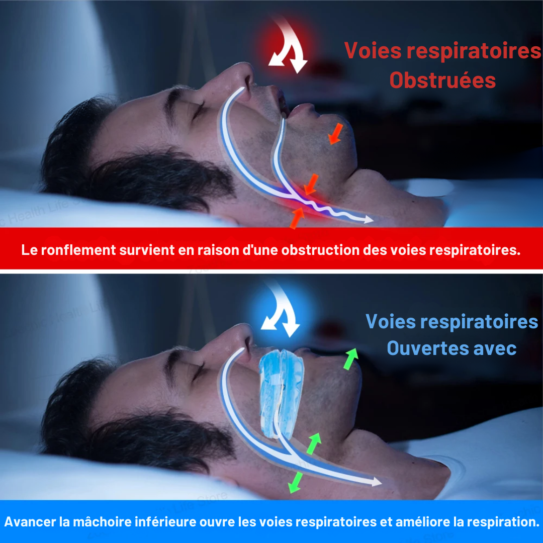 Orthèse d'avancée mandibulaire anti-ronflement à réglage précis et confort doux