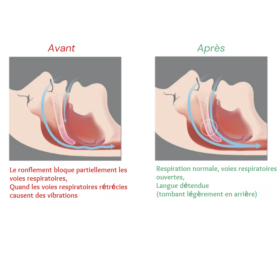 Orthèse d'avancée mandibulaire - Gouttière anti ronflement, CareSommeil™