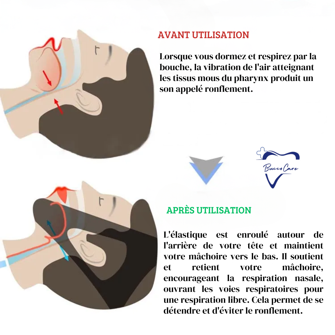 Orthèse Anti-Ronflement pour l'Apnée du Sommeil CareSommeil™